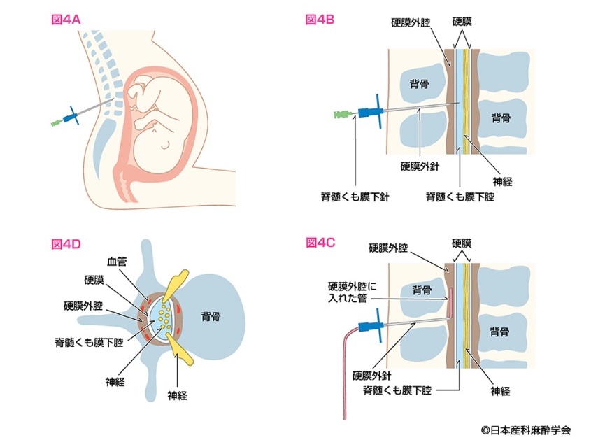 硬膜外麻酔の方法